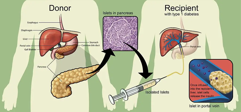 Heart,liver,lungs and kidney transplantation
